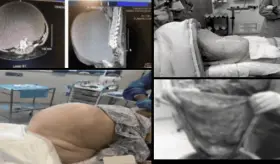 Hallan quiste ovárico de 54 cm en mujer de 71 años con histerectomía previa