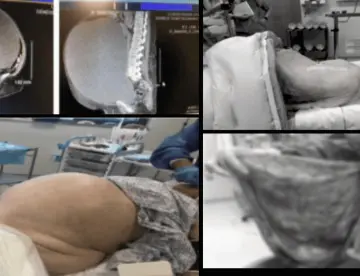 Hallan quiste ovárico de 54 cm en mujer de 71 años con histerectomía previa