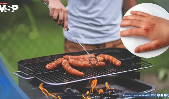 El 75% de las quemaduras en barbacoas se deben al uso incorrecto de líquidos inflamables, estudio
