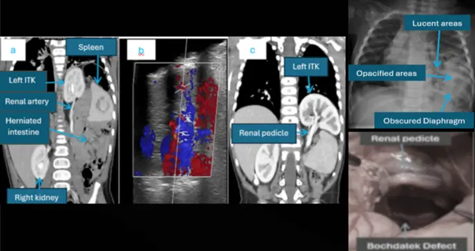 Descubren riñón alojado en cavidad torácica de un bebé de 6 meses con hernia diafragmática y taquipnea 