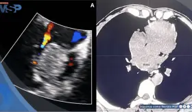 Detectan raro tumor cardíaco maligno en paciente con síntomas comunes de cardiomiopatía
