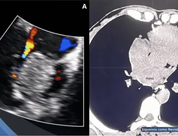 Detectan raro tumor cardíaco maligno en paciente con síntomas comunes de cardiomiopatía