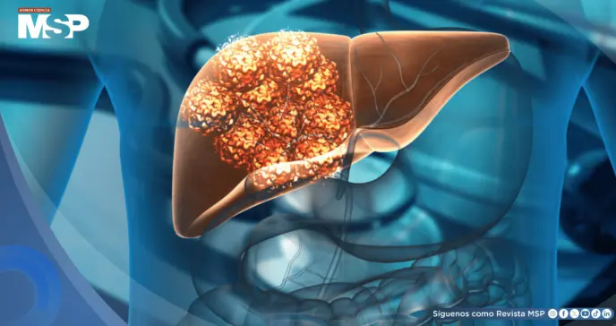 El 60% de los casos de cáncer de hígado se pueden prevenir, según estudio