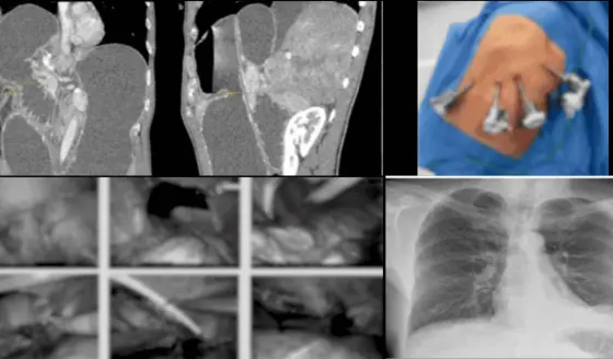 Hernia diafragmática no detectada tras accidente es reparada con cirugía robótica 7 años después