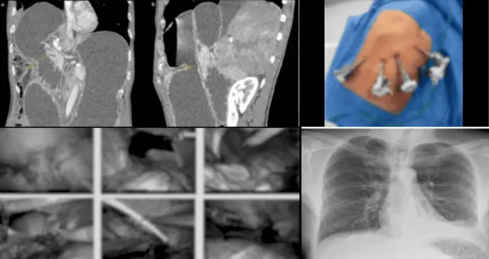 Hernia diafragmática no detectada tras accidente es reparada con cirugía robótica 7 años después