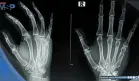 ¿Dolor o rigidez en las manos? Podría ser artrosis y detectarla a tiempo mejoraría el tratamientol