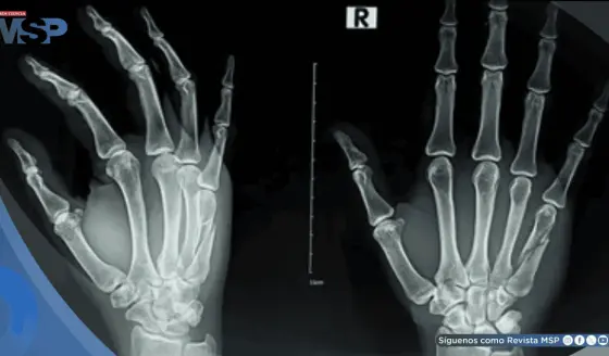 ¿Dolor o rigidez en las manos? Podría ser artrosis y detectarla a tiempo mejoraría el tratamientol