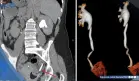 Dolor abdominal y hematuria revelan rara obstrucción ureteral causada por copa menstrual mal posicionada