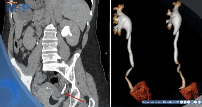 Dolor abdominal y hematuria revelan rara obstrucción ureteral causada por copa menstrual mal posicionada