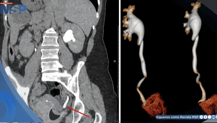 Dolor abdominal y hematuria revelan rara obstrucción ureteral causada por copa menstrual mal posicionada