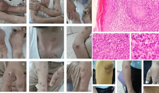 Paciente en hemodi&aacute;lisis con leishmaniasis cut&aacute;nea recibe antimoniato de meglumina sin da&ntilde;o renal
