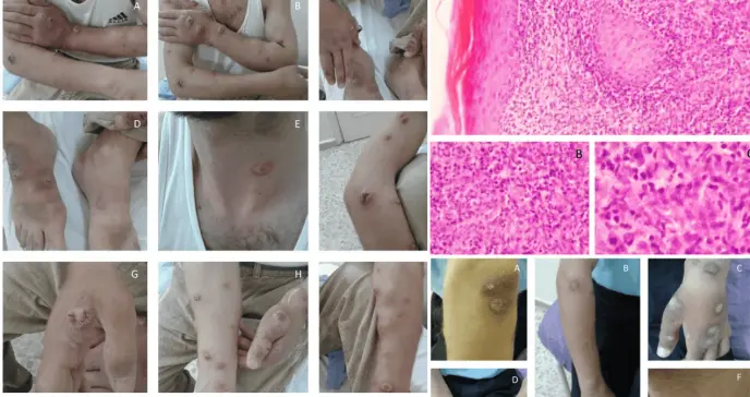 Paciente en hemodiálisis con leishmaniasis cutánea recibe antimoniato de meglumina sin daño renal