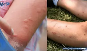 ¿Eres imán de mosquitos? Descubre por qué te pican más y cómo evitarlo