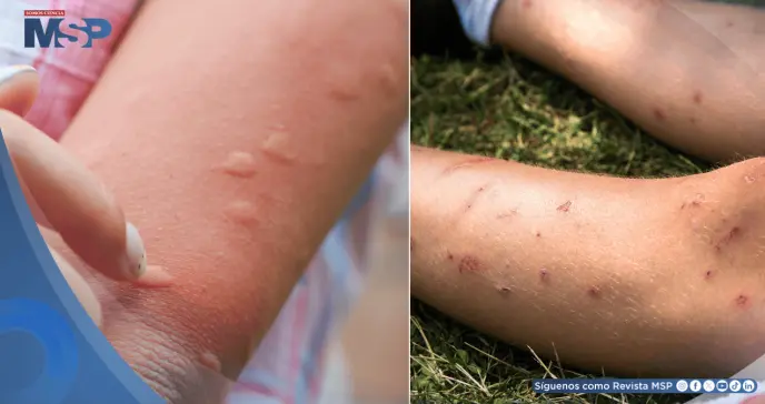 ¿Eres imán de mosquitos? Descubre por qué te pican más y cómo evitarlo