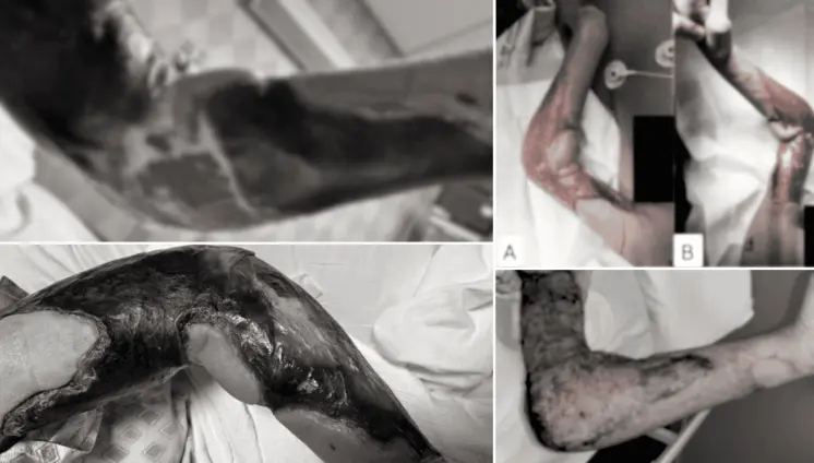 Paciente con síndrome de hiper IgE desarrolla necrosis extensa por Staphylococcus aureus Paciente con síndrome de hiper IgE desarrolla necrosis extensa por Staphylococcus aureus