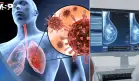 Infecciones respiratorias pueden reactivar el cáncer de mama años después del diagnóstico