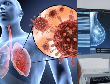 Infecciones respiratorias pueden reactivar el cáncer de mama años después del diagnóstico