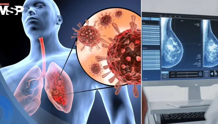 Infecciones respiratorias pueden reactivar el cáncer de mama años después del diagnóstico