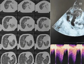 Hipertensión pulmonar en lactante no vacunada con leucocitosis grave por tos ferina severa