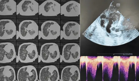 Hipertensión pulmonar en lactante no vacunada con leucocitosis grave por tos ferina severa