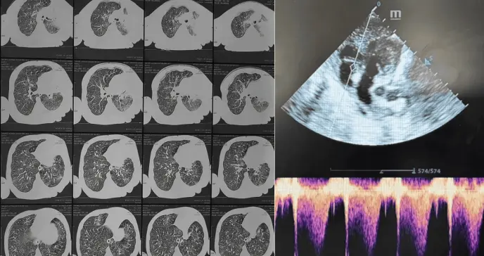 Hipertensión pulmonar en lactante no vacunada con leucocitosis grave por tos ferina severa