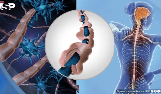 La esclerosis múltiple podría manifestarse hasta 15 años antes de su diagnóstico clínico, según estudio