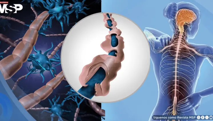 La esclerosis múltiple podría manifestarse hasta 15 años antes de su diagnóstico clínico, según estudio La esclerosis múltiple podría manifestarse hasta 15 años antes de su diagnóstico clínico, según estudio