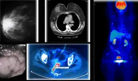 Detectan c&aacute;ncer de mama y c&aacute;ncer rectal simult&aacute;neos con reactivaci&oacute;n de hepatitis B tras quimioterapia