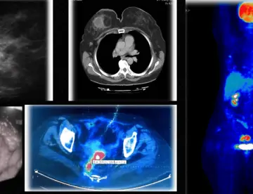 Detectan cáncer de mama y cáncer rectal simultáneos con reactivación de hepatitis B tras quimioterapia