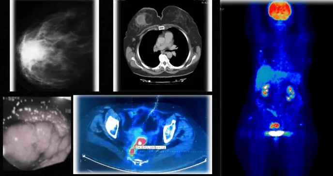 Detectan cáncer de mama y cáncer rectal simultáneos con reactivación de hepatitis B tras quimioterapia