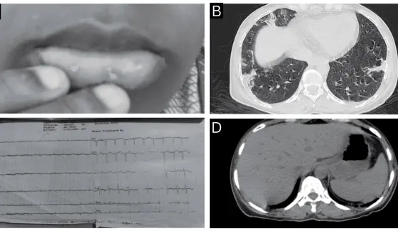 Hemorragia gastrointestinal superior y neumonía como manifestación inicial de lupus eritematoso sistémico