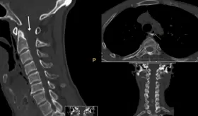 Accidente de tránsito provoca rotura en la hipofaringe por golpe cervical en paciente de 64 años