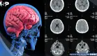Identifican biomarcador que predice respuesta a tratamientos antipsicóticos en esquizofrenia