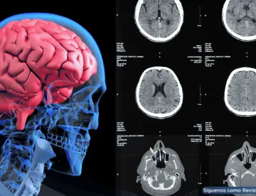 Identifican biomarcador que predice respuesta a tratamientos antipsicóticos en esquizofrenia
