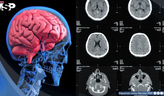 Identifican biomarcador que predice respuesta a tratamientos antipsicóticos en esquizofrenia