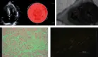 Amiloidosis AL no diagnosticada causa shock cardiogénico y falla multiorgánica en paciente con disnea