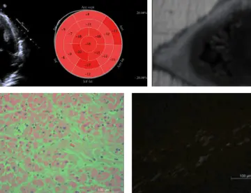 Amiloidosis AL no diagnosticada causa shock cardiogénico y falla multiorgánica en paciente con disnea