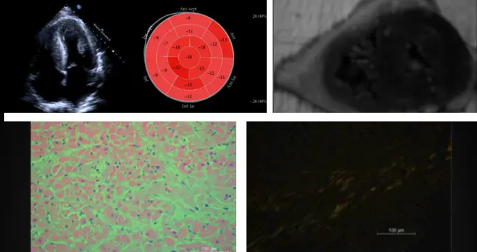 Amiloidosis AL no diagnosticada causa shock cardiogénico y falla multiorgánica en paciente con disnea