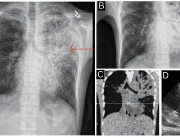 Tos persistente y dolor torácico revelan tuberculosis pericárdica con taponamiento cardíaco en joven