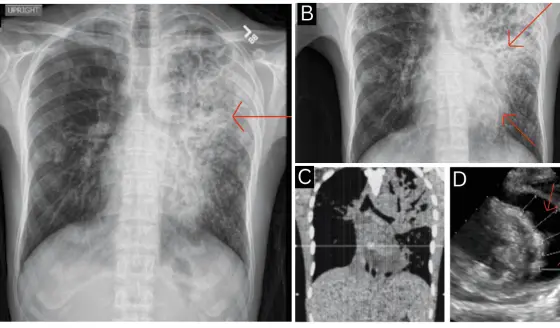 Tos persistente y dolor torácico revelan tuberculosis pericárdica con taponamiento cardíaco en joven