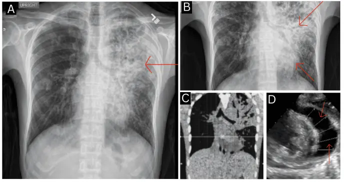 Tos persistente y dolor torácico revelan tuberculosis pericárdica con taponamiento cardíaco en joven