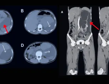 Rotura espontánea de riñón por obstrucción congénita se manifiesta con dolor lumbar, vómitos y fiebre