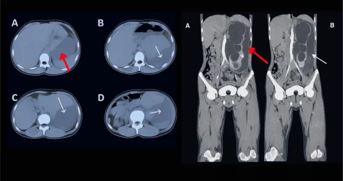 Rotura espontánea de riñón por obstrucción congénita se manifiesta con dolor lumbar, vómitos y fiebre