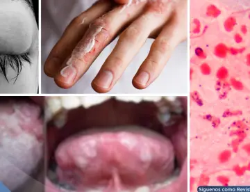Gonorrea: qué es, síntomas, tratamiento, prevención y cómo evitar sus daños permanentes 