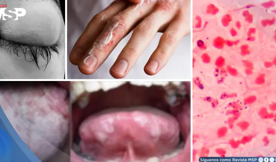 Gonorrea: qué es, síntomas, tratamiento, prevención y cómo evitar sus daños permanentes 
