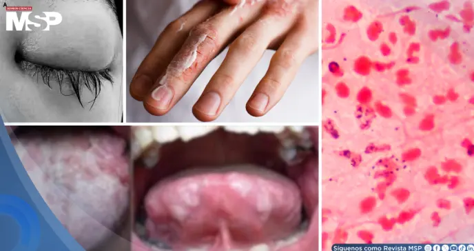 Gonorrea: qué es, síntomas, tratamiento, prevención y cómo evitar sus daños permanentes 
