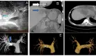 Absceso hepático amébico rompe la vena cava inferior y causa embolia pulmonar masiva en paciente
