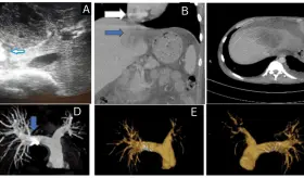 Absceso hepático amébico rompe la vena cava inferior y causa embolia pulmonar masiva en paciente