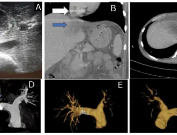 Absceso hepático amébico rompe la vena cava inferior y causa embolia pulmonar masiva en paciente