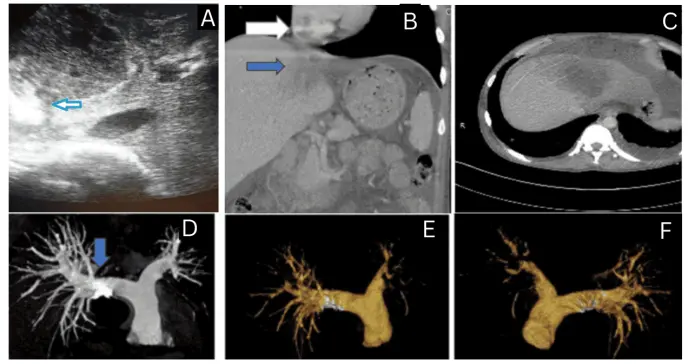 Absceso hepático amébico rompe la vena cava inferior y causa embolia pulmonar masiva en paciente